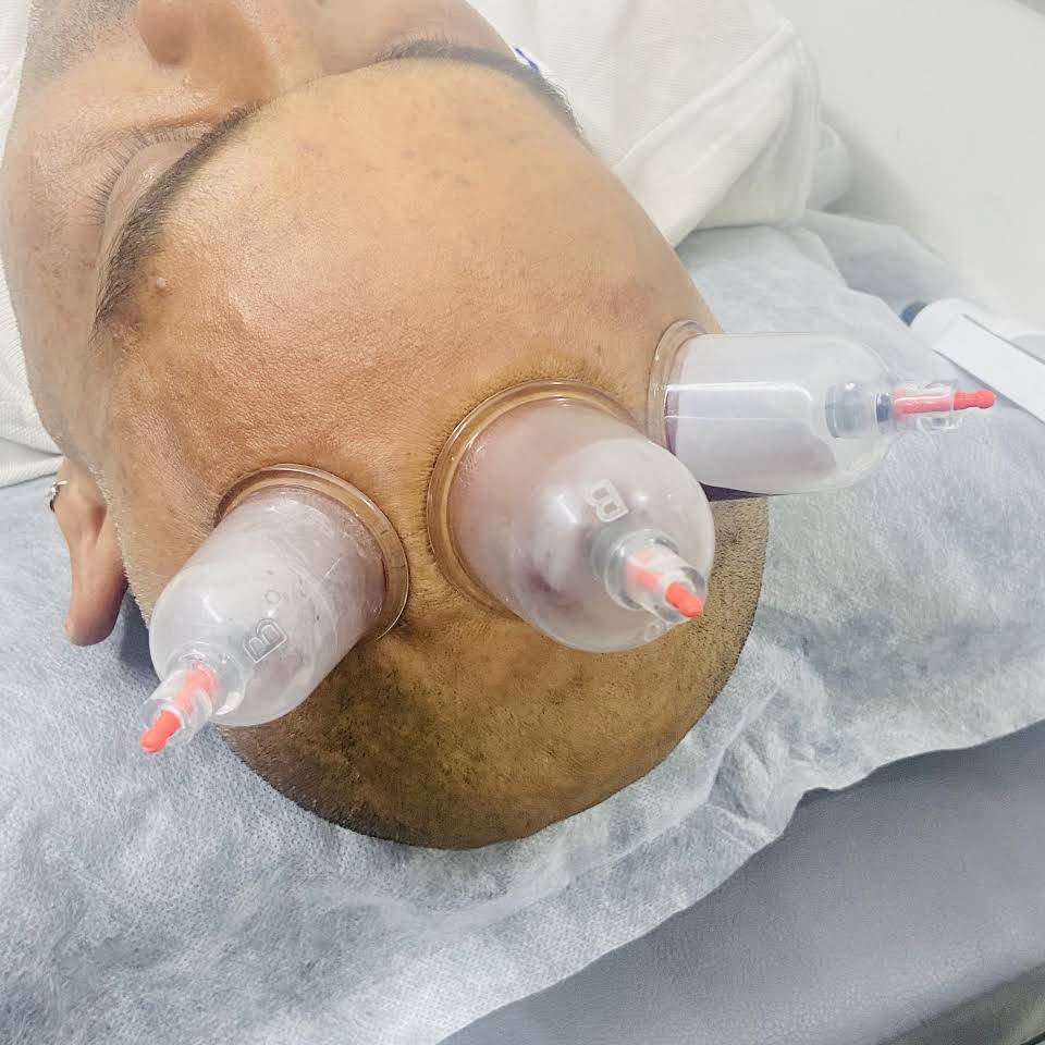 Cupping Therapy