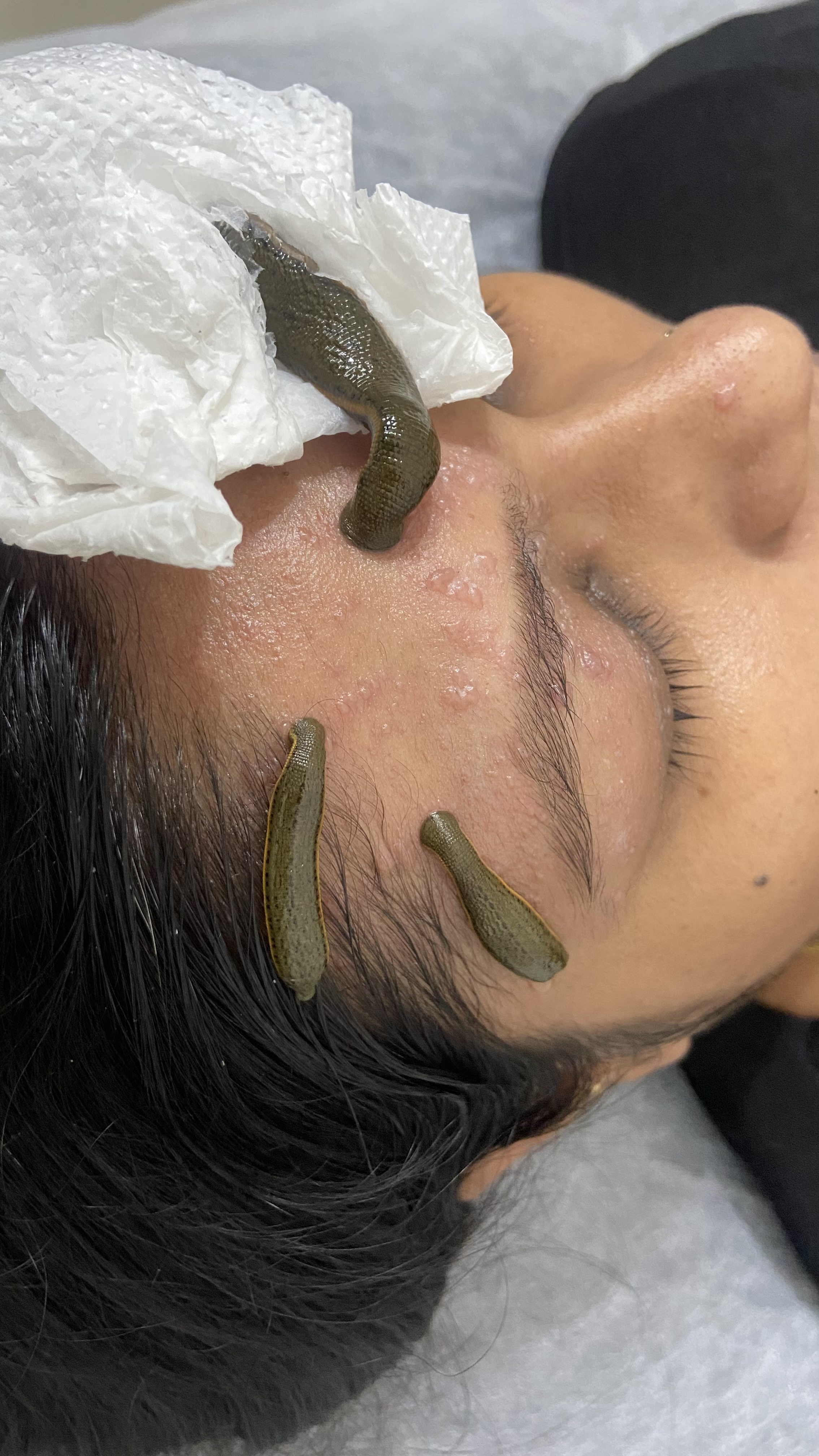 Leech Therapy